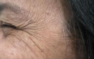 Região dos olhos antes do tratamento