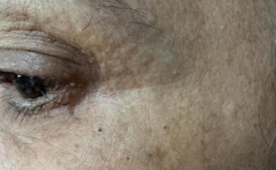 Região dos olhos depois do tratamento